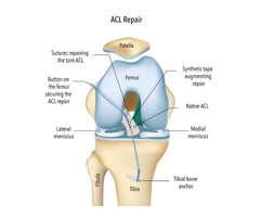 ACL Rupture Repair Helps Restore Knee Stability Safely