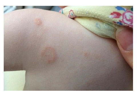 Learn About Ringworm in Babies and Children with Child Care Centre Harrisdale