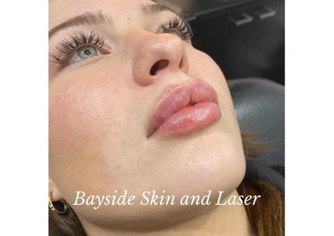Carbon Facial Melbourne – Glow with Bayside Skin and Laser
