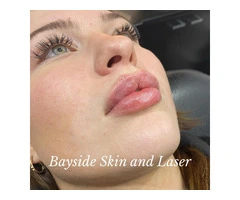Carbon Facial Melbourne – Glow with Bayside Skin and Laser