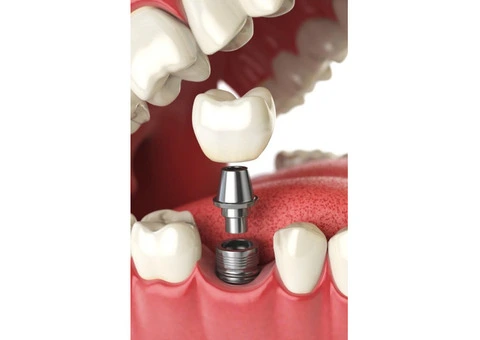 Sydney Dentist – Premium Wisdom Teeth Removal!