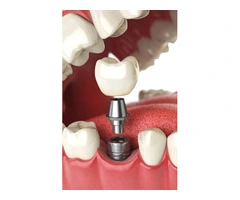 Sydney Dentist – Premium Wisdom Teeth Removal!