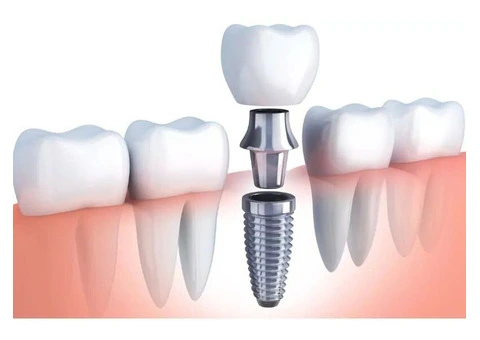 Restore Your Confidence with Dental Implants