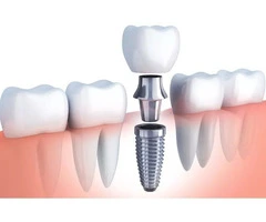 Restore Your Confidence with Dental Implants
