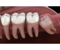 Fast Wisdom Teeth Removal for All Ages