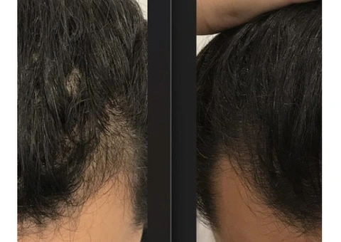 Unlock Confidence with the Best Hair Regrowth Treatment in Sydney