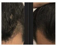 Unlock Confidence with the Best Hair Regrowth Treatment in Sydney
