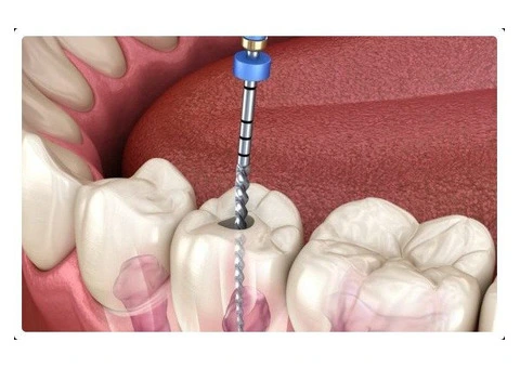 Affordable Root Canal Melbourne  Pain Free & Expert Care