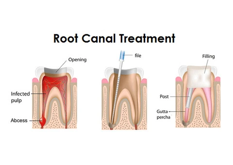 Wisdom Teeth Removal: What You Need to Know