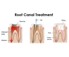 Wisdom Teeth Removal: What You Need to Know