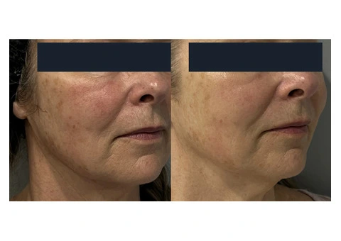 HIFU Treatment at Cosmetic Tattooing Melbourne