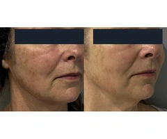 HIFU Treatment at Cosmetic Tattooing Melbourne