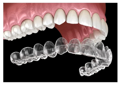 Affordable Invisible Braces – Smile Confidently!