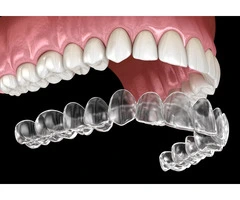 Affordable Invisible Braces – Smile Confidently!