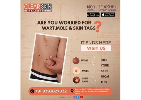 best vbeam laser treatment in india