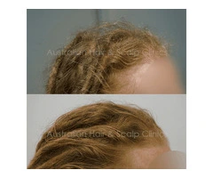 Personalised Hair Loss Solutions in Sydney