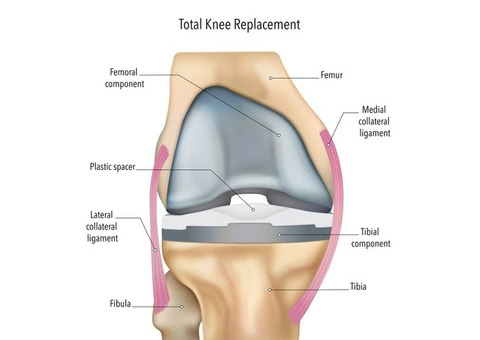 Expert Care for Your Knee Replacement in Melbourne