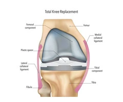 Expert Care for Your Knee Replacement in Melbourne
