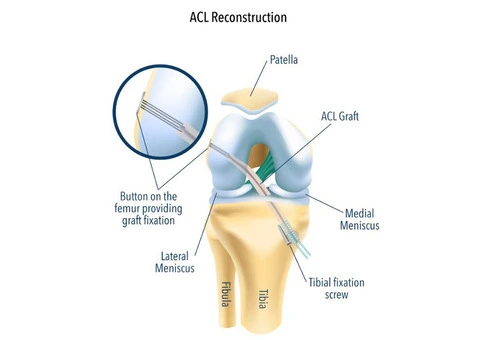 Trusted Care for Your ACL Reconstruction Surgery