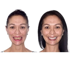 Dental implants Melbourne | My implant Dentist