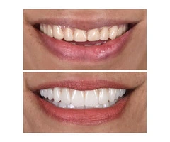 Cosmetic Dentist Melbourne | My implant Dentist