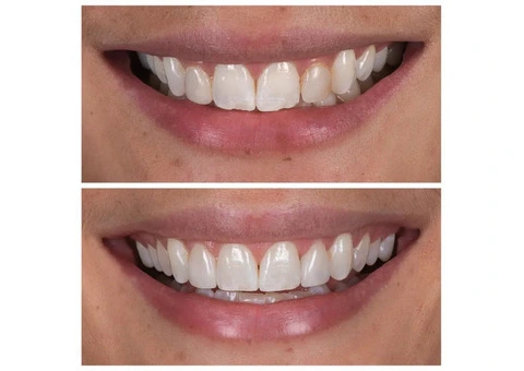 Composite Veneers Melbourne | My implant Dentist