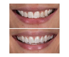 Composite Veneers Melbourne | My implant Dentist