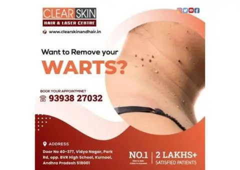 facial port wine stain Treatment in india