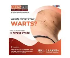 facial port wine stain Treatment in india