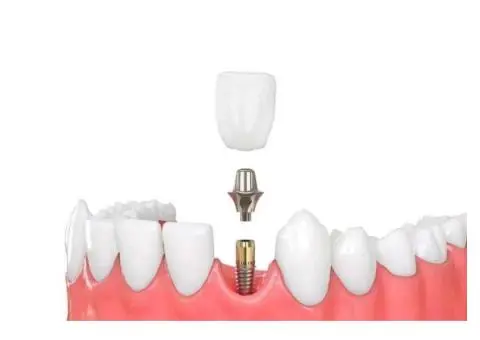 Trusted Family & Cosmetic Dentist | Supreme Dental Cowes - 4/8