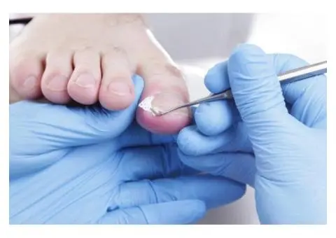 Get the Best Ingrown Toenail Treatment in Black Rock