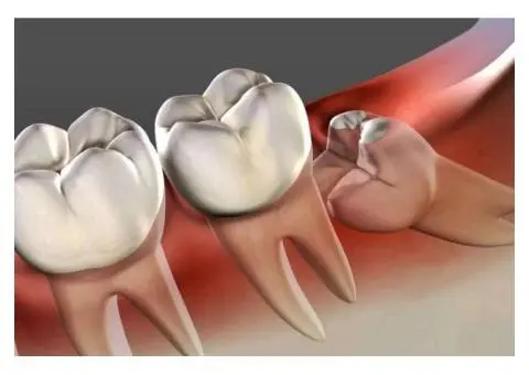 Wisdom Tooth Removal for Stress-Free Recovery