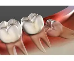 Wisdom Tooth Removal for Stress-Free Recovery