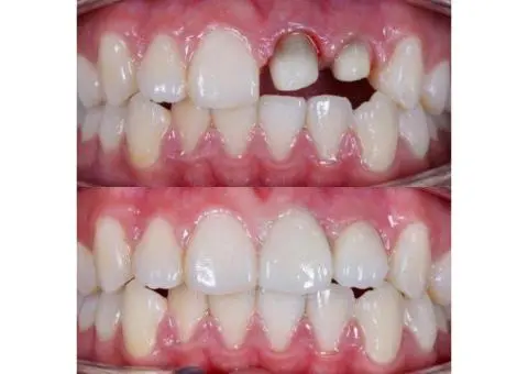 Affordable Tooth Cap Solutions