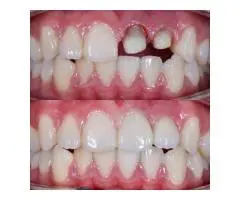 Affordable Tooth Cap Solutions