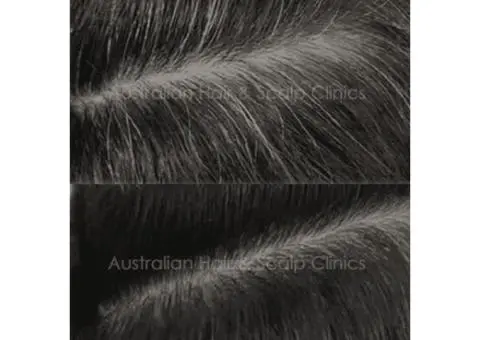 Natural Hair Loss Treatment in Brisbane