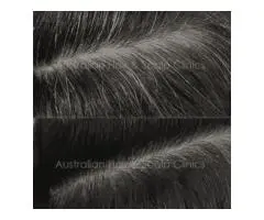 Natural Hair Loss Treatment in Brisbane