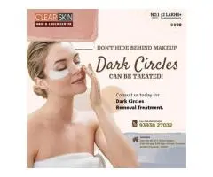 Birthmark removal treatment in india