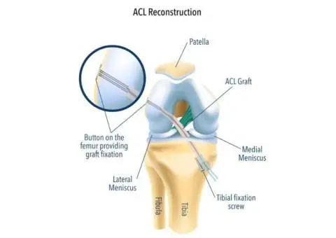 Restore Your Knee Stability with ACL Reconstruction Surgery