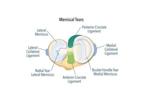 Discover the Most Trusted Surgeon for Meniscus Tear Surgery