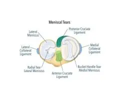 Discover the Most Trusted Surgeon for Meniscus Tear Surgery