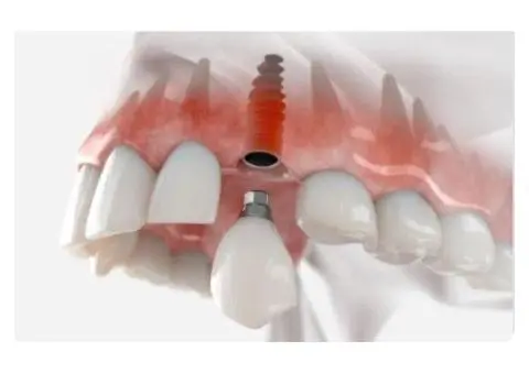 Dental Implants Penrith