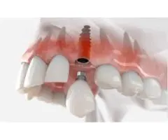 Dental Implants Penrith