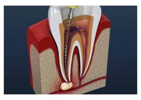 Understanding Root Canal Therapy in Murwillumbah – What You Need to Know