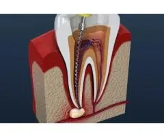 Understanding Root Canal Therapy in Murwillumbah – What You Need to Know