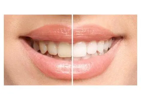 Teeth Whitening Adelaide