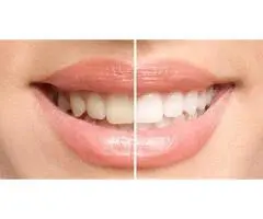 Teeth Whitening Adelaide
