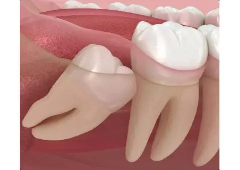 Dental Extraction of Third Molars by Trusted Professionals