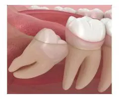 Dental Extraction of Third Molars by Trusted Professionals