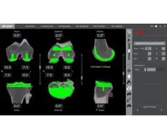 How Can Robotic Partial Knee Replacement Surgery Benefit You?